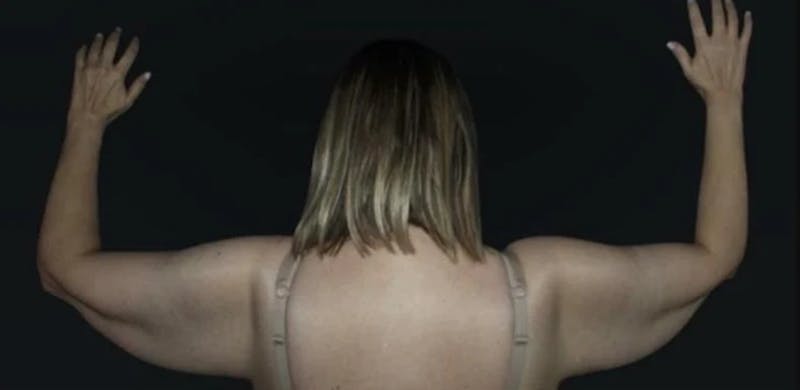 Arm Lift Before & After Gallery - Patient 408133 - Image 1