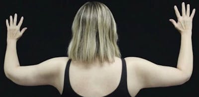 Arm Lift Before & After Gallery - Patient 408133 - Image 2