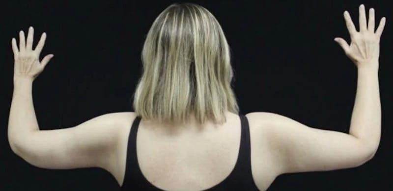 Arm Lift Before & After Gallery - Patient 408133 - Image 2