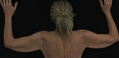 Arm Lift Before & After Gallery - Patient 257134 - Image 1