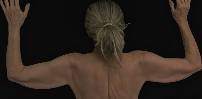 Arm Lift Before & After Gallery - Patient 257134 - Image 1