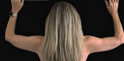 Arm Lift Before & After Gallery - Patient 257134 - Image 2