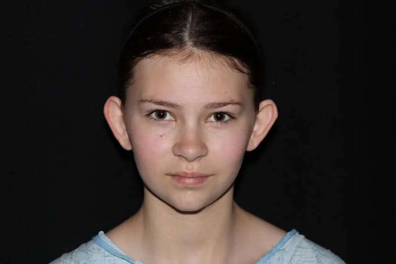 Ear Surgery Before & After Gallery - Patient 172713 - Image 1