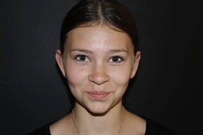 Ear Surgery Before & After Gallery - Patient 172713 - Image 2