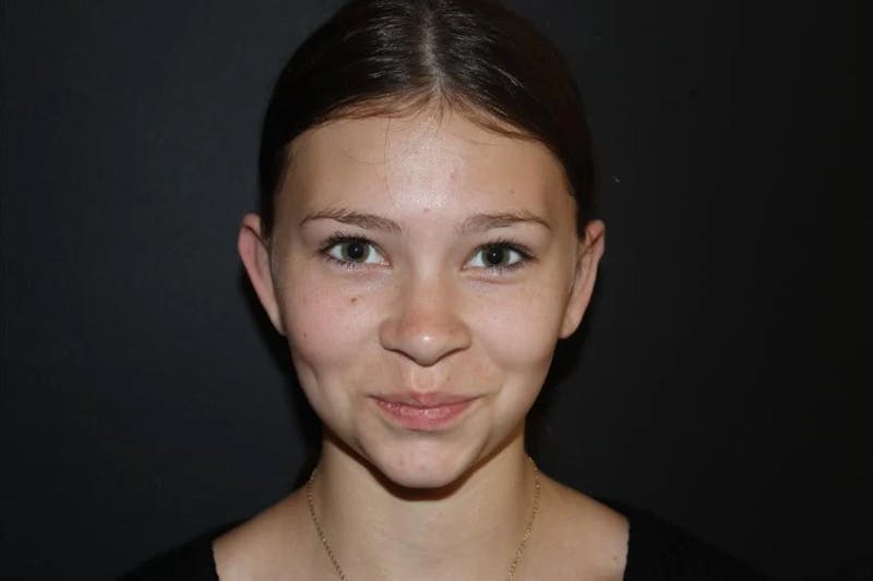 Ear Surgery Before & After Gallery - Patient 172713 - Image 2