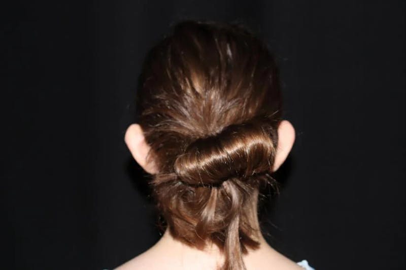 Ear Surgery Before & After Gallery - Patient 172713 - Image 3