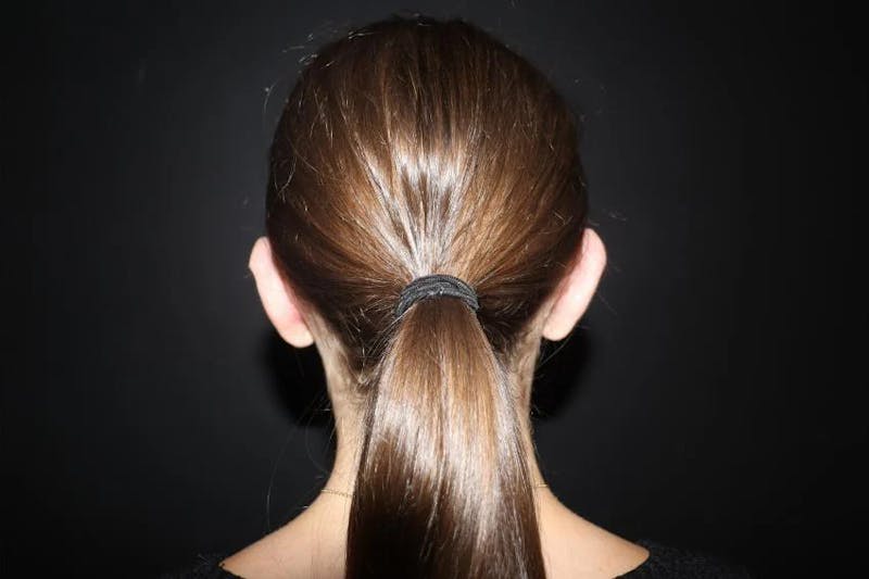 Ear Surgery Before & After Gallery - Patient 172713 - Image 4