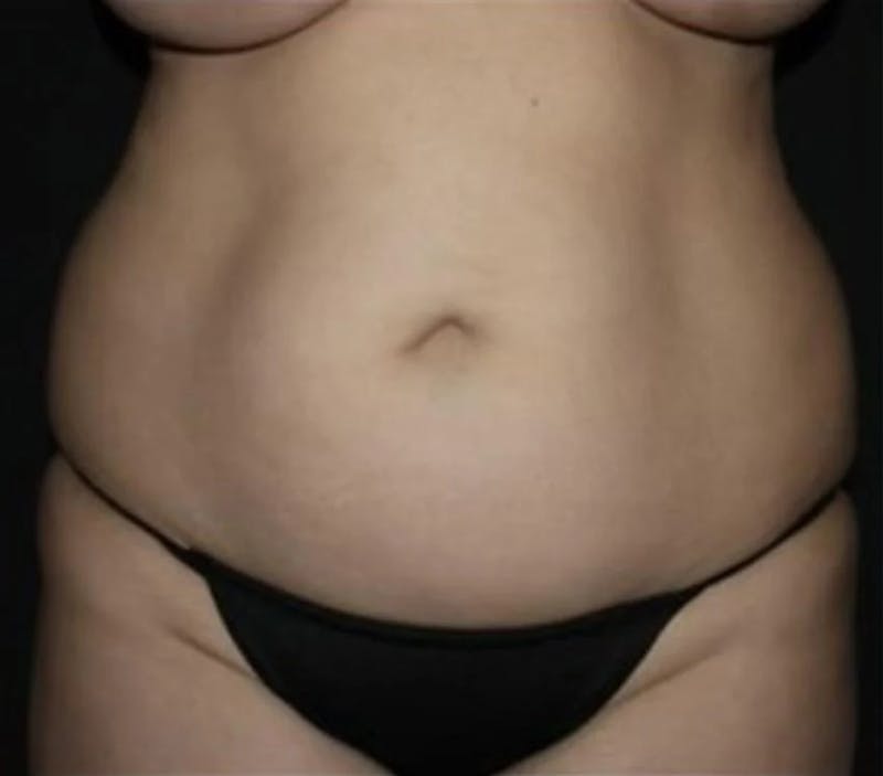 Liposuction Before & After Gallery - Patient 284923 - Image 1