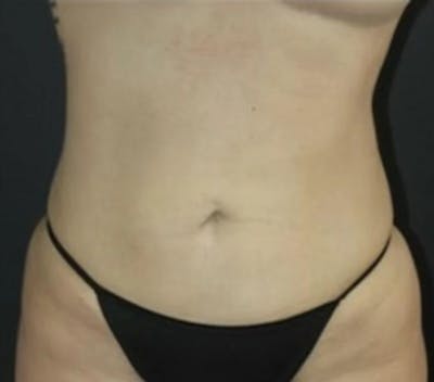 Liposuction Before & After Gallery - Patient 284923 - Image 2