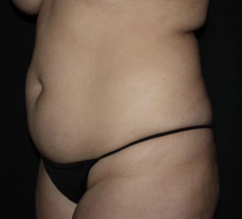 Liposuction Before & After Gallery - Patient 284923 - Image 3
