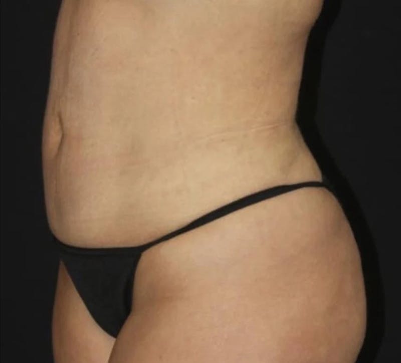 Liposuction Before & After Gallery - Patient 284923 - Image 4
