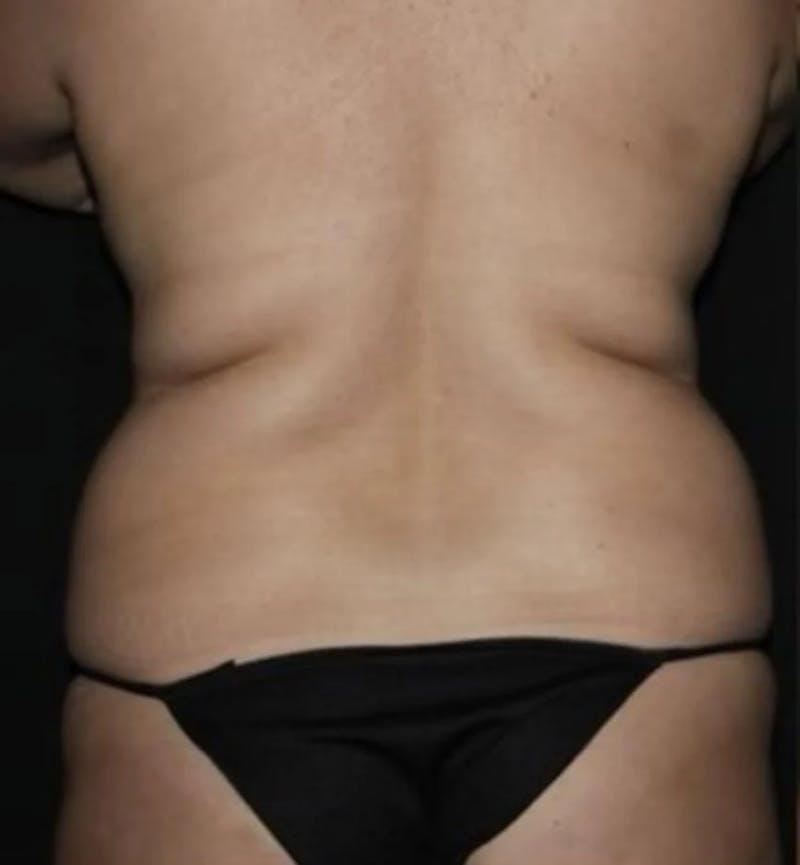 Liposuction Before & After Gallery - Patient 284923 - Image 5