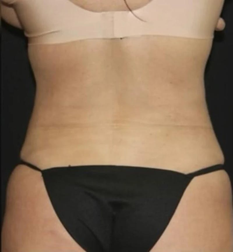Liposuction Before & After Gallery - Patient 284923 - Image 6