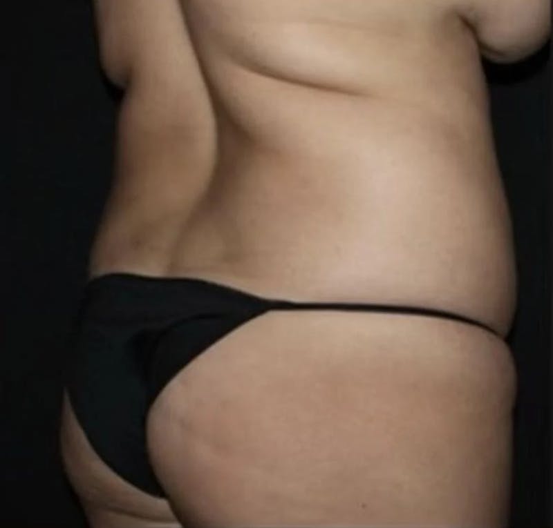 Liposuction Before & After Gallery - Patient 284923 - Image 7
