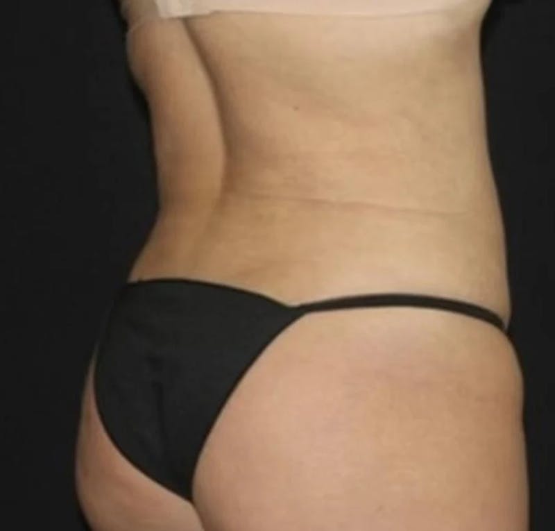 Liposuction Before & After Gallery - Patient 284923 - Image 8