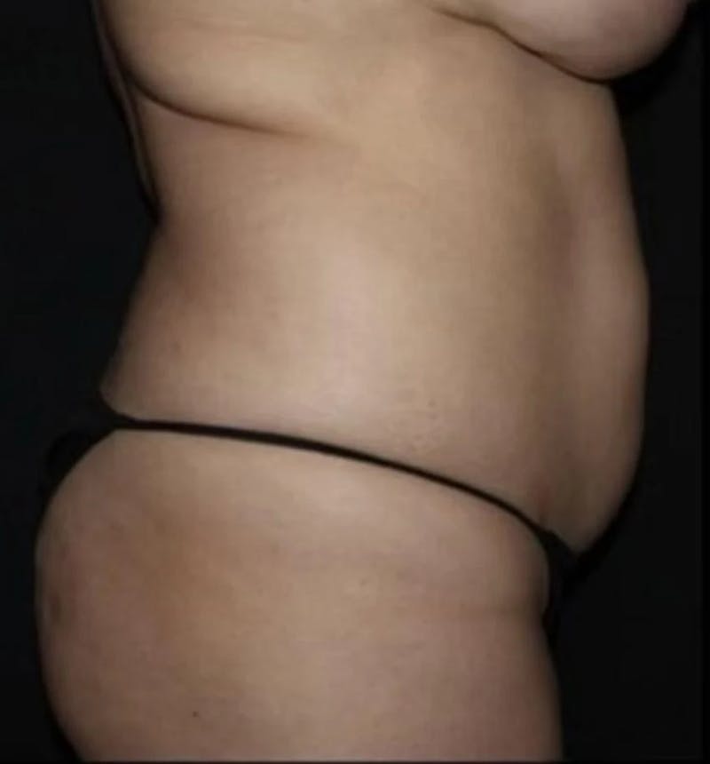 Liposuction Before & After Gallery - Patient 284923 - Image 9