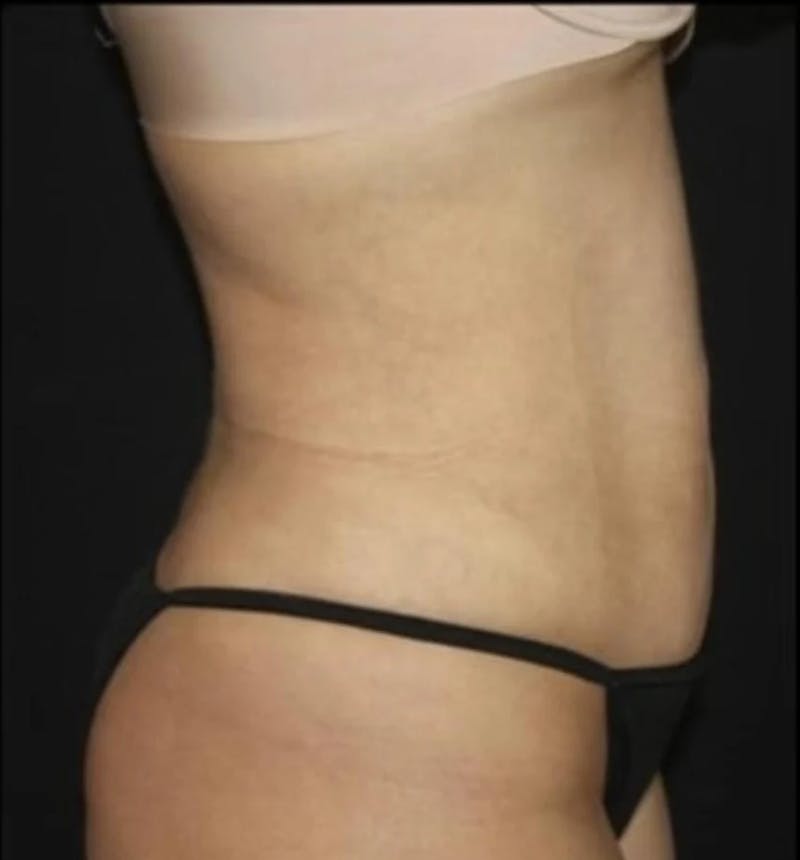 Liposuction Before & After Gallery - Patient 284923 - Image 10