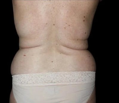 Liposuction Before & After Gallery - Patient 144678 - Image 1