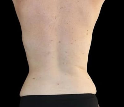 Liposuction Before & After Gallery - Patient 144678 - Image 2