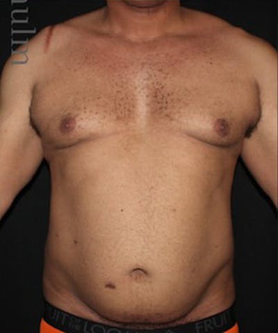 Liposuction Before & After Gallery - Patient 198763 - Image 1