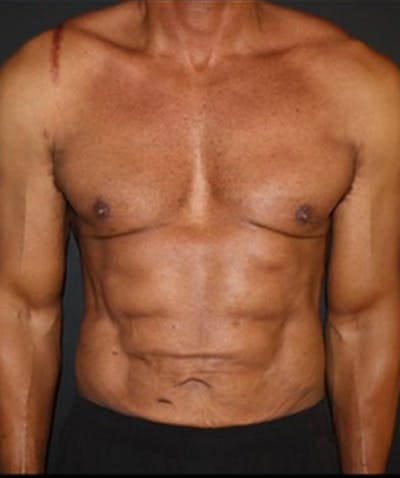 Liposuction Before & After Gallery - Patient 198763 - Image 2