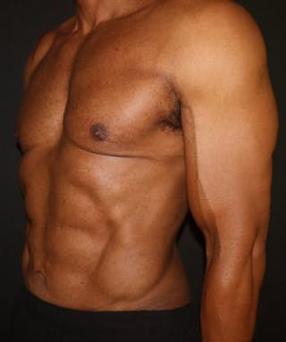 Liposuction Before & After Gallery - Patient 198763 - Image 4