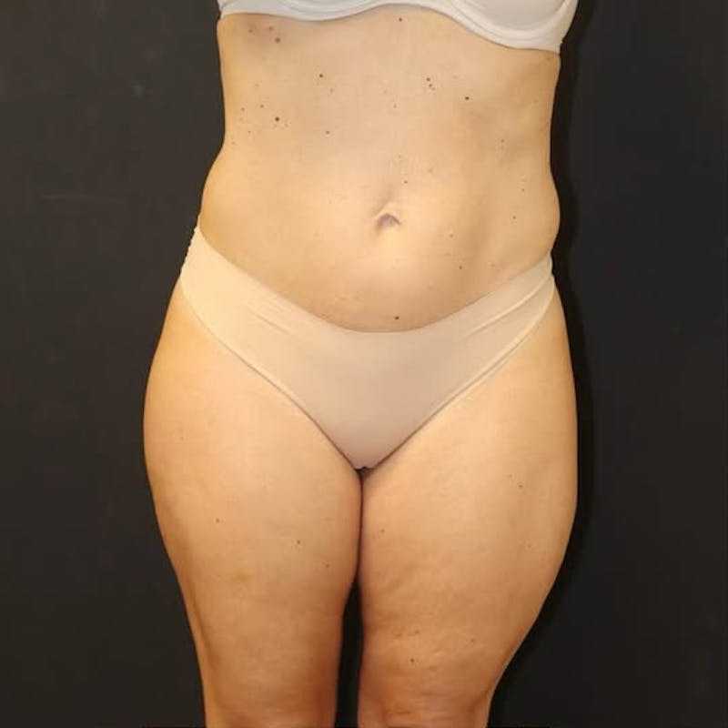 Liposuction Before & After Gallery - Patient 120898 - Image 1