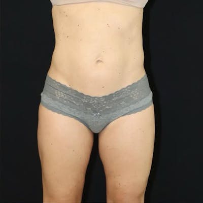 Liposuction Before & After Gallery - Patient 120898 - Image 2