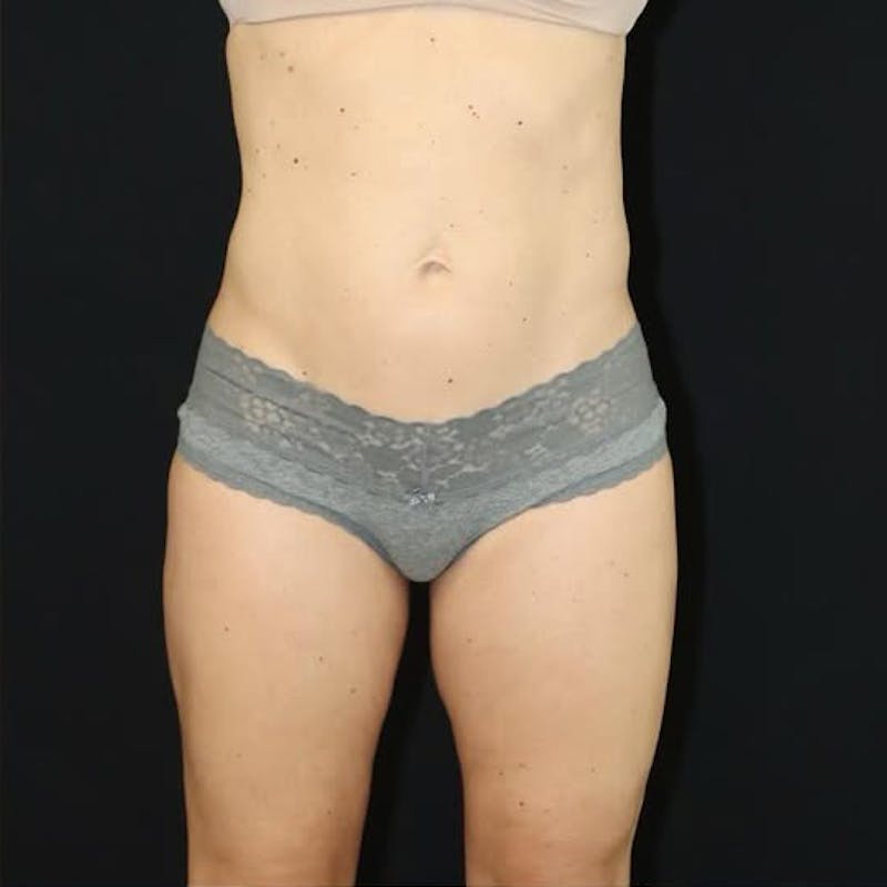 Liposuction Before & After Gallery - Patient 120898 - Image 2