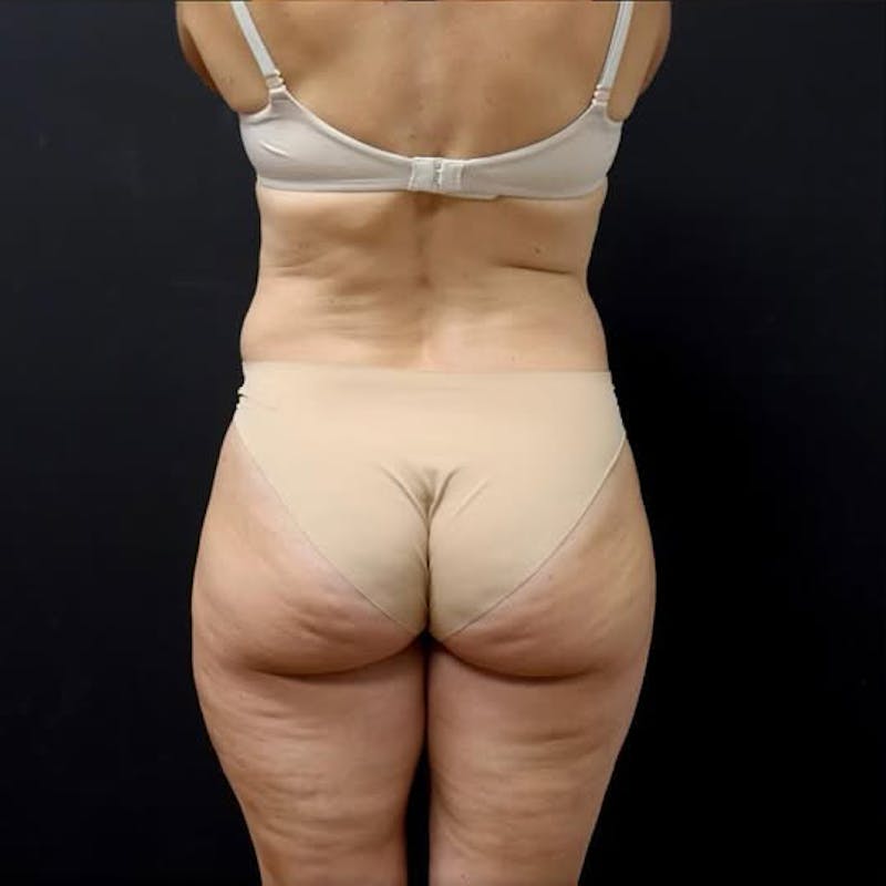 Liposuction Before & After Gallery - Patient 120898 - Image 3