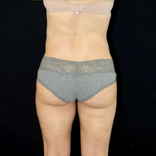 Liposuction Before & After Gallery - Patient 120898 - Image 4