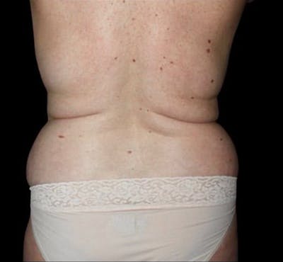 Liposuction Before & After Gallery - Patient 100787 - Image 1