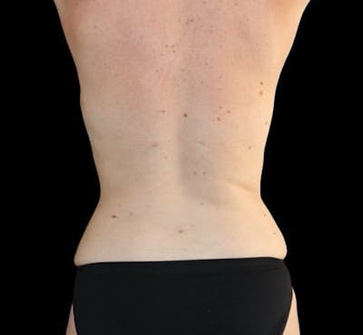 Liposuction Before & After Gallery - Patient 100787 - Image 2