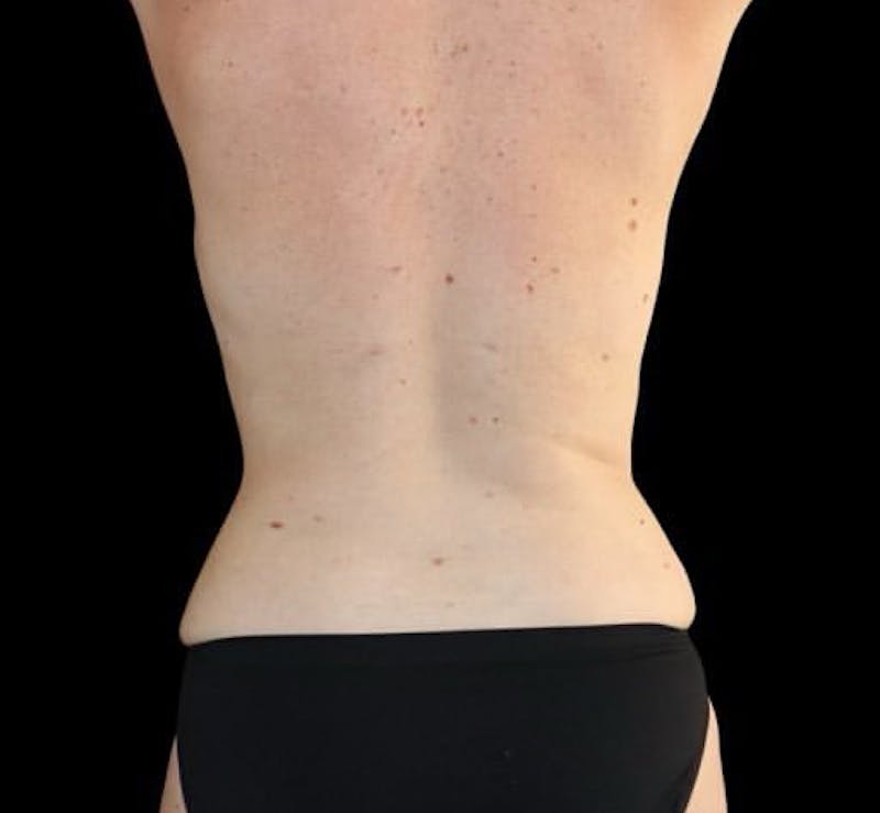 Liposuction Before & After Gallery - Patient 100787 - Image 2