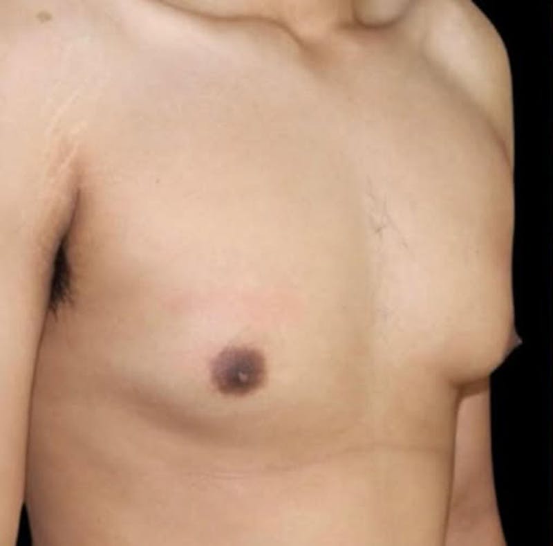 Gynecomastia Before & After Gallery - Patient 165954 - Image 1