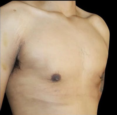 Gynecomastia Before & After Gallery - Patient 165954 - Image 2