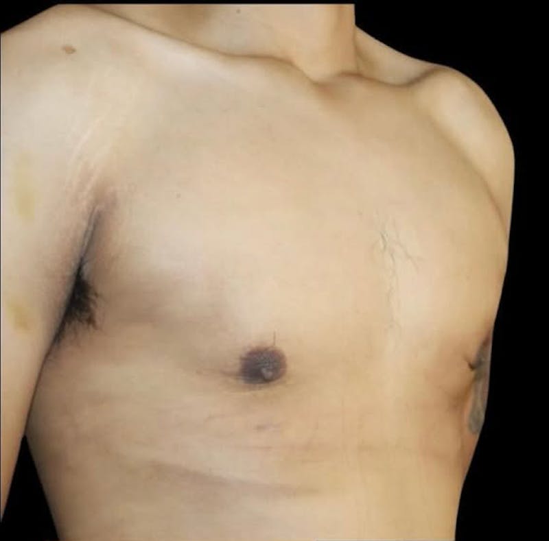 Gynecomastia Before & After Gallery - Patient 165954 - Image 2