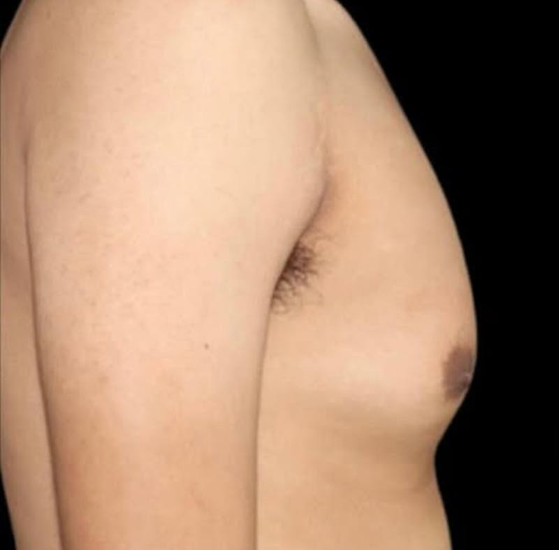 Gynecomastia Before & After Gallery - Patient 165954 - Image 3