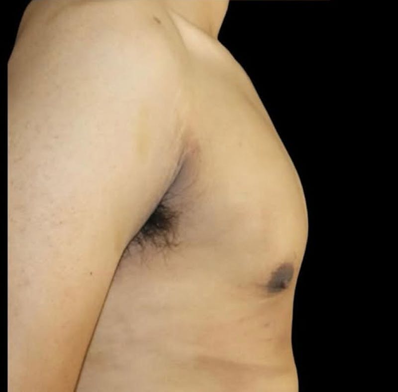 Gynecomastia Before & After Gallery - Patient 165954 - Image 4