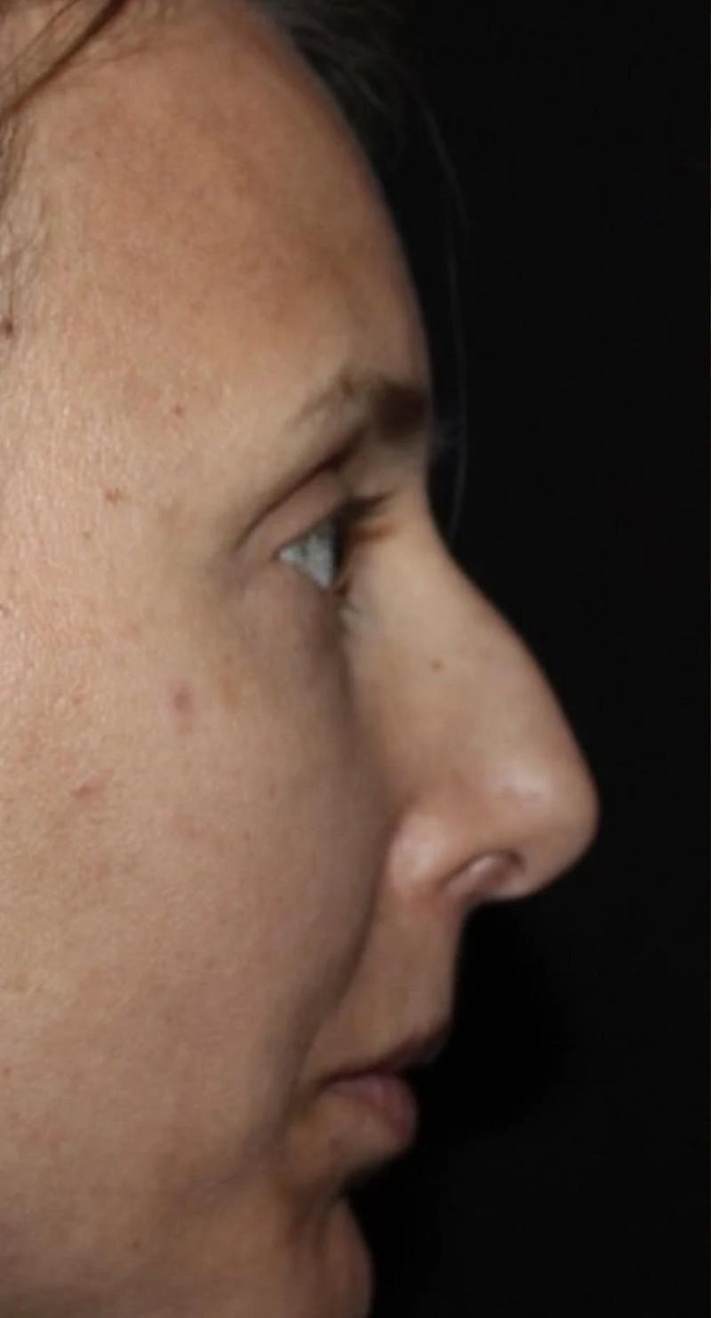 Rhinoplasty Before & After Gallery - Patient 270335 - Image 1