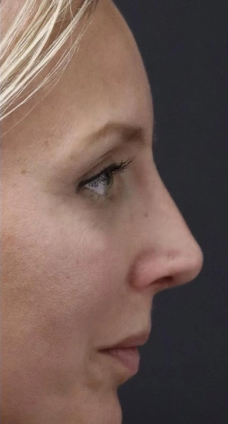 Rhinoplasty Before & After Gallery - Patient 270335 - Image 2