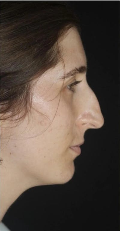 Rhinoplasty Before & After Gallery - Patient 217111 - Image 1
