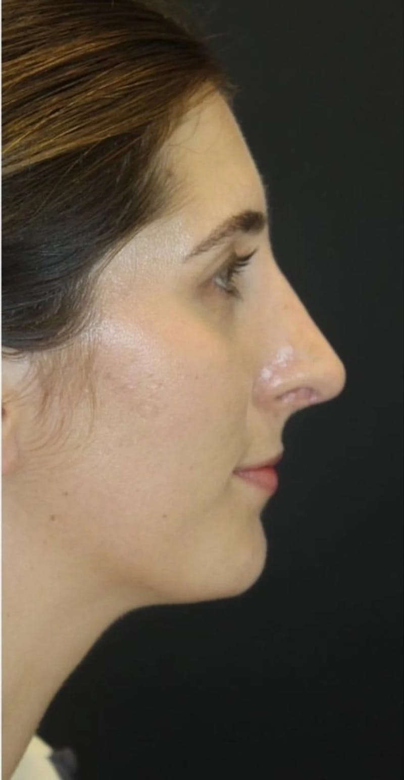 Rhinoplasty Before & After Gallery - Patient 217111 - Image 2