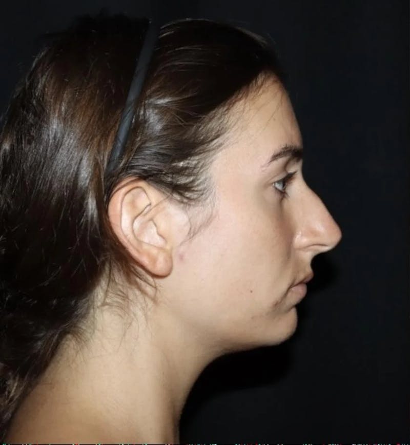 Rhinoplasty Before & After Gallery - Patient 103713 - Image 1