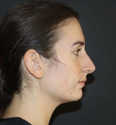 Rhinoplasty Before & After Gallery - Patient 103713 - Image 2