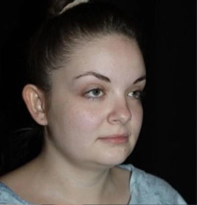 Submental Liposuction Before & After Gallery - Patient 117369 - Image 1