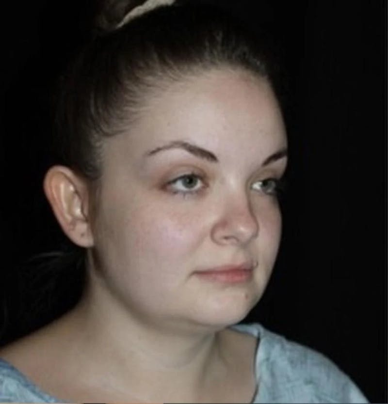 Submental Liposuction Before & After Gallery - Patient 117369 - Image 1