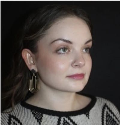 Submental Liposuction Before & After Gallery - Patient 117369 - Image 2