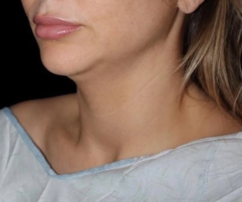 Submental Liposuction Before & After Gallery - Patient 234480 - Image 1