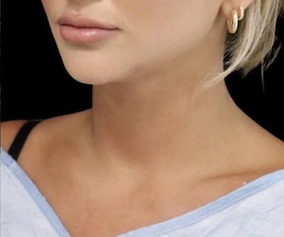 Submental Liposuction Before & After Gallery - Patient 234480 - Image 2